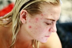 skin health acne struggle