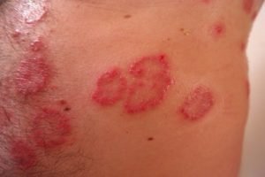 skin health rash