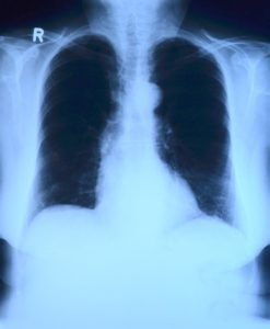 x ray image of lungs