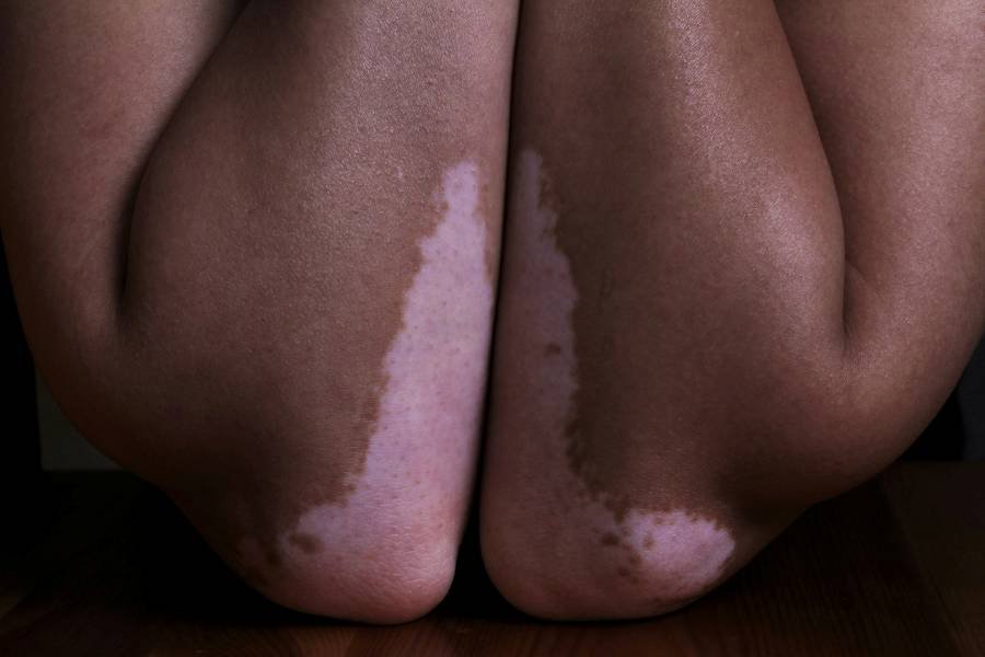 Vitiligo on arms and elbows